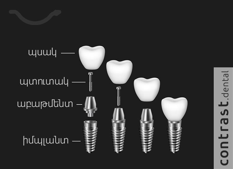 Ատամների իմպլանտների բաղկացուցիչ մասեր