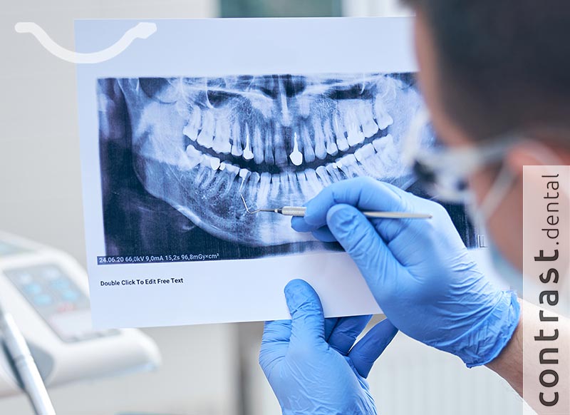 Complicated tooth extraction in Yerevan Complicated tooth extraction in Yerevan