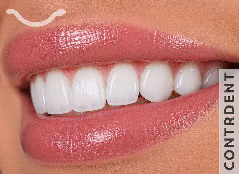 Dental Veneers in Yerevan — Ceramic Veneers Installation