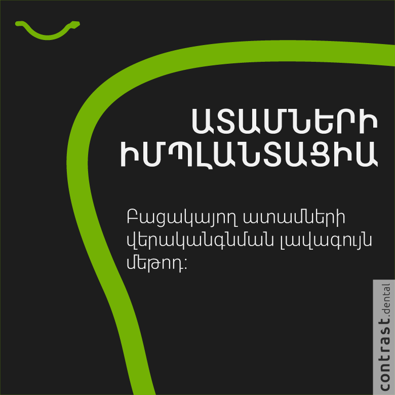 Ատամների իմպլանտացիա